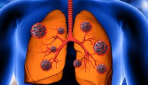 fibrosis quistica | genos laboratorio de genetica